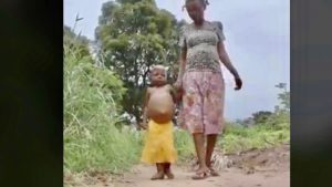 RDC 1 million d'enfants courent un risque de malnutrition aiguë