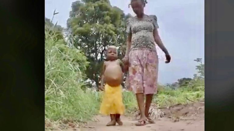 RDC 1 million d'enfants courent un risque de malnutrition aiguë