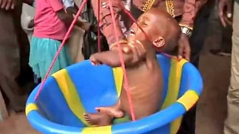 enfant frappé de malnutrition à Tshikapa