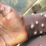 Monkeypox