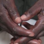 épidémie variole de singe