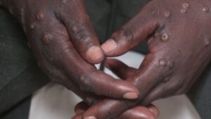 épidémie variole de singe