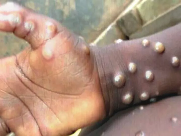 Cas de Monkeypox à Kinshasa : Traitement en Cours à l’Hôpital Général de Référence